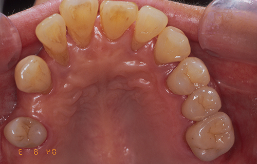 上顎から見た口中の写真 治療前