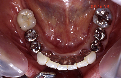 下顎から見た口中の写真 治療後