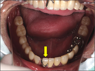 下顎からみた治療後の口中の写真 Before（保険の入れ歯装着）