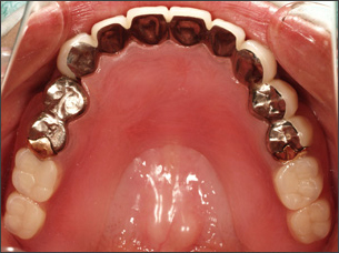 歯周病治療後に審美的な入れ歯を装着した写真