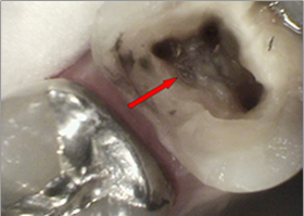 左上第一大臼歯部、根管口明示（マイクロスコープによる）