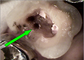 左上第一大臼歯部、根管口明示（マイクロスコープによる）