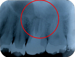 左上第一大臼歯部デンタルレントゲン（初診時）