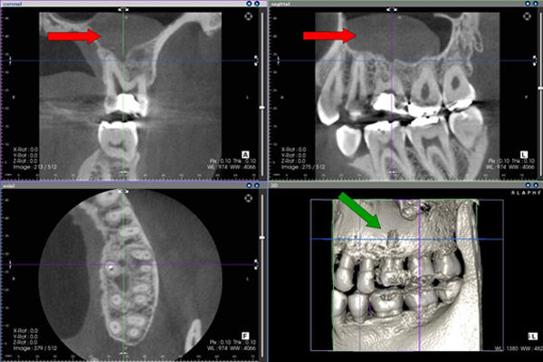 歯科用CTスキャンによる診断