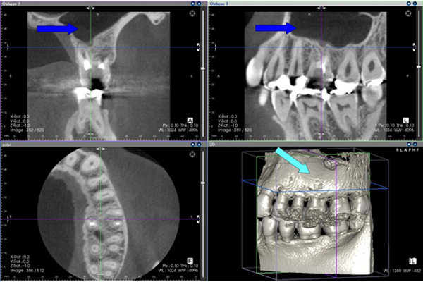 歯科用CTスキャンにて治療経過の確認