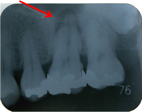 左上第一大臼歯部 デンタルレントゲン（初診時）