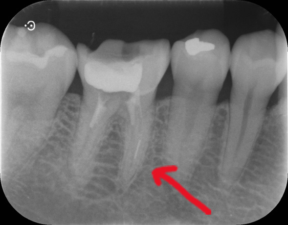 初診時デンタルレントゲン（46:右側下顎第一大臼歯）