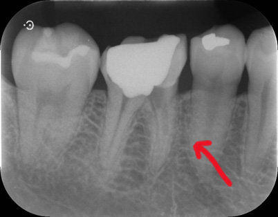 デンタルレントゲン写真（破折ファイル除去確認）（46:右側下顎第一大臼歯）