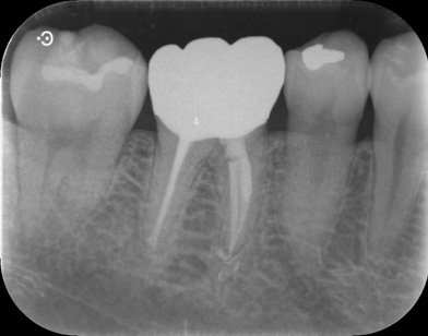補綴（銀歯を被せた治療）後1年経過のデンタルレントゲン像