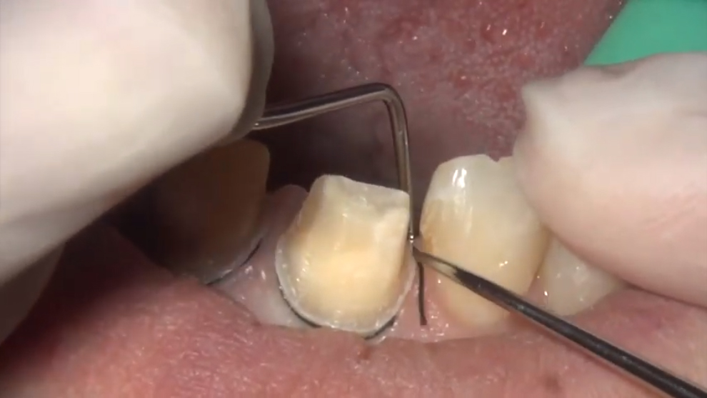 歯肉圧排の実際（簡易動画）
