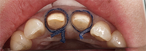 歯肉圧排（一時的に排除）して、正確な歯型をとっている状態