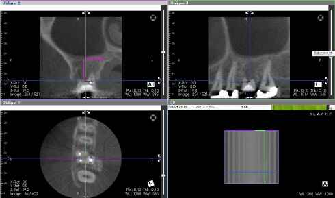 抜歯前の歯科用CTによる画像診断