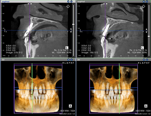 術後CT画像診断